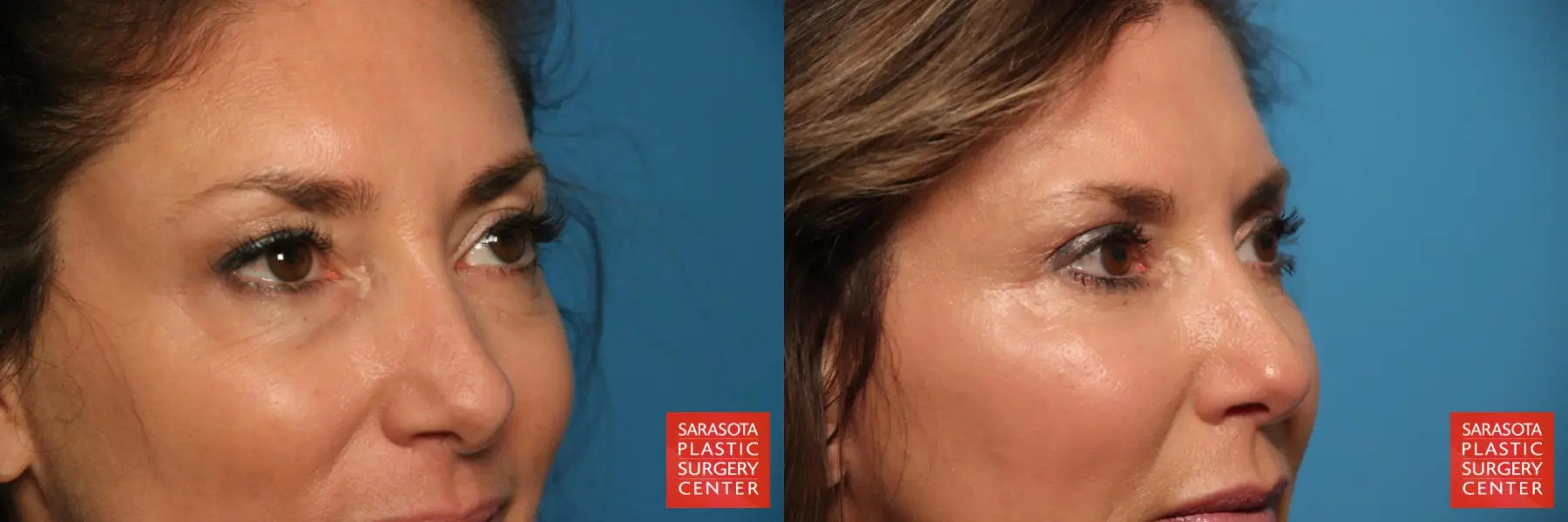 Eyelid Surgery: Patient 6 - Before and After 6