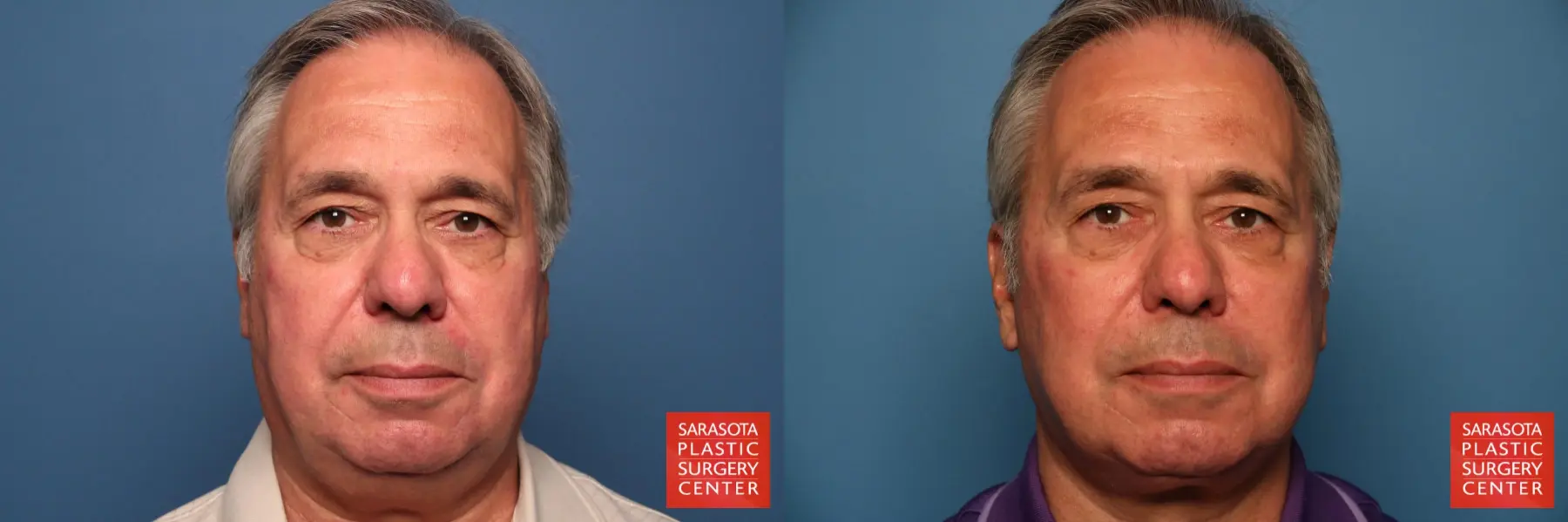 Facelift - Male: Patient 4 - Before and After  