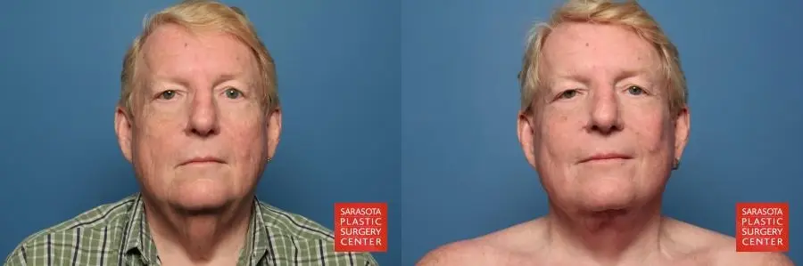 Facelift - Male: Patient 2 - Before and After  