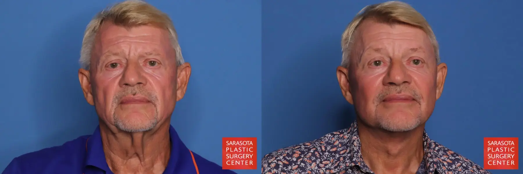 Facelift - Male: Patient 5 - Before and After  