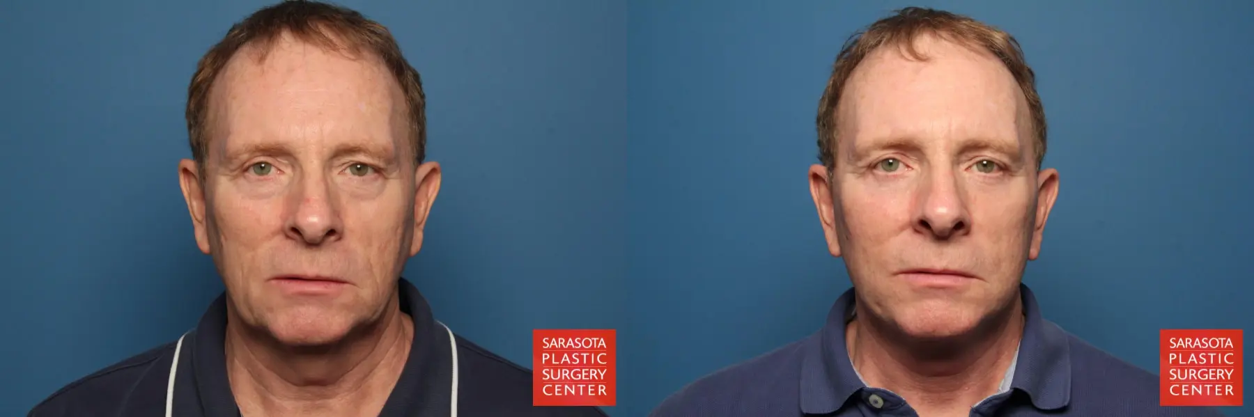 Facelift - Male: Patient 3 - Before and After  