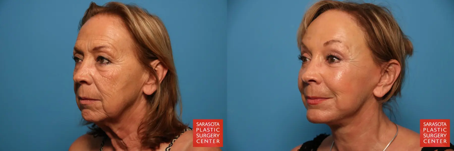 Facelift: Patient 33 - Before and After 2