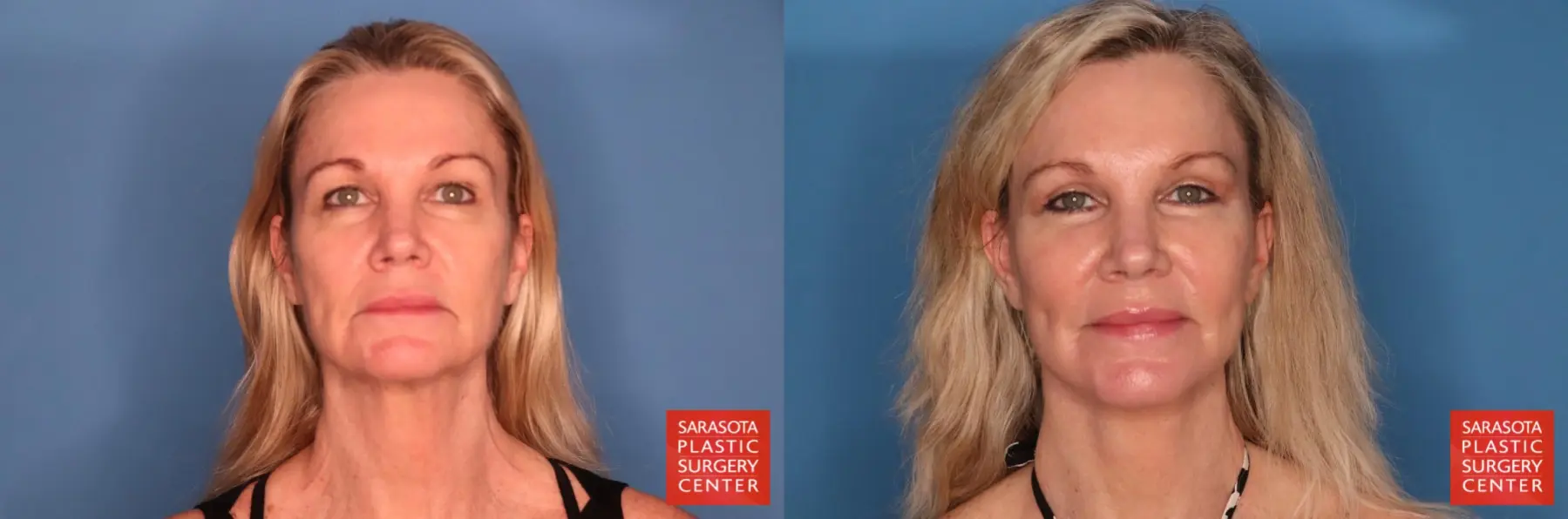 Facelift: Patient 108 - Before and After 1