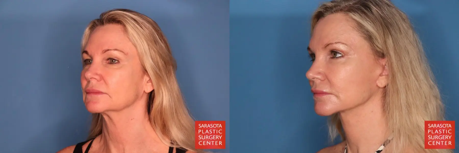 Facelift: Patient 108 - Before and After 2