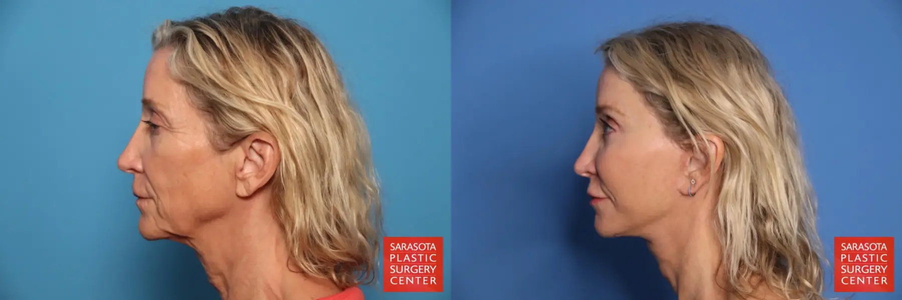 Facelift: Patient 2 - Before and After 3