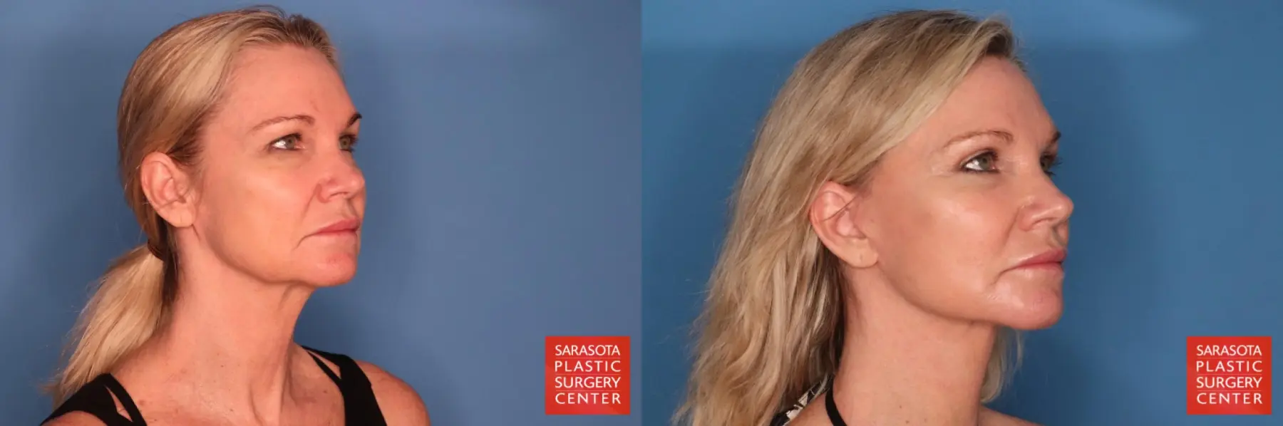 Facelift: Patient 108 - Before and After 4