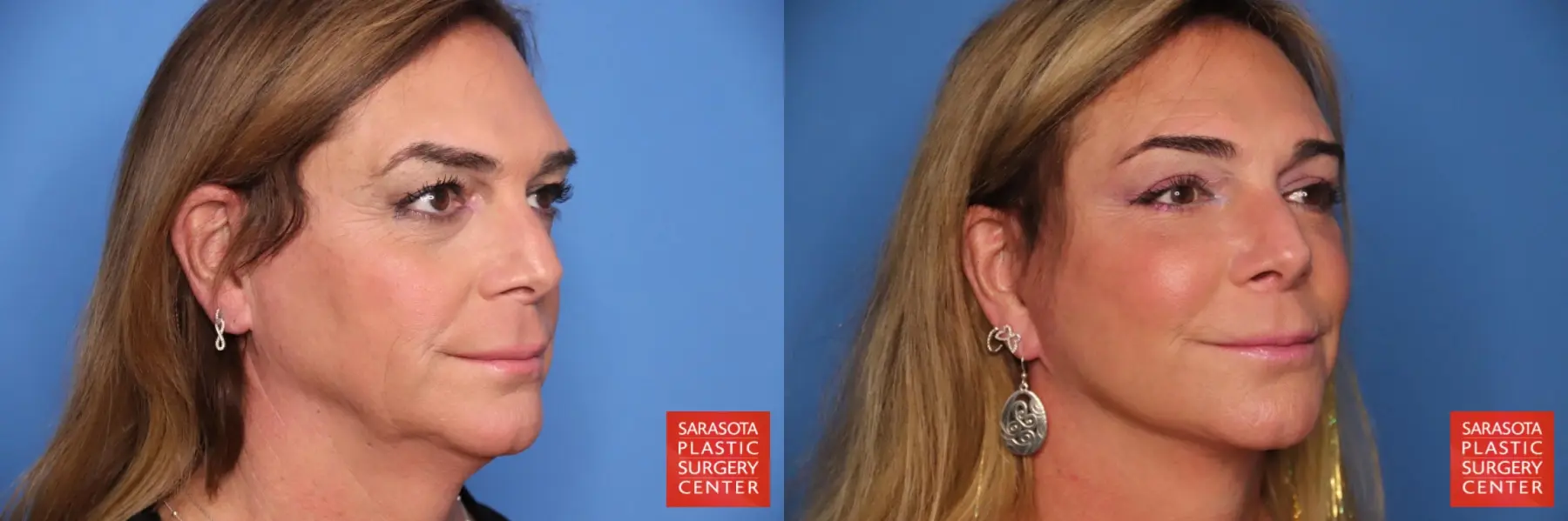 Facelift: Patient 79 - Before and After 4