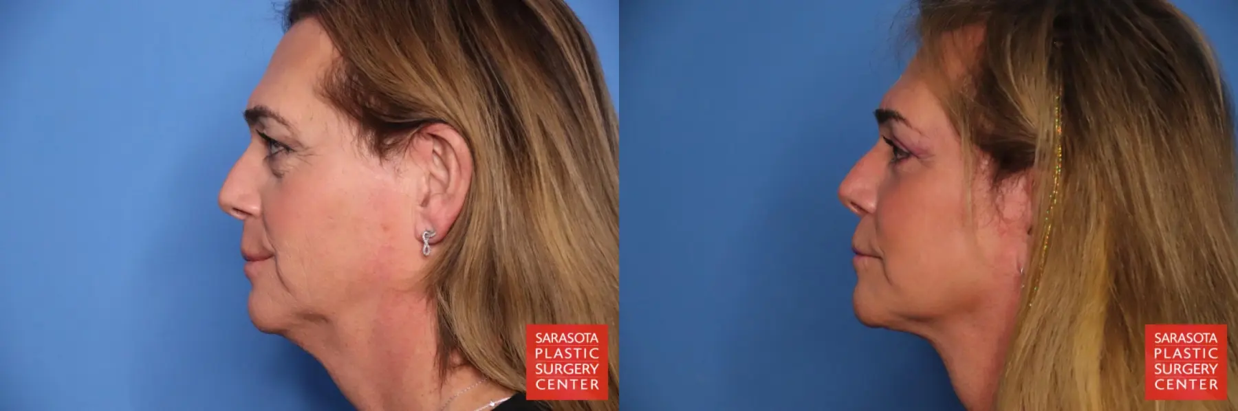 Facelift: Patient 79 - Before and After 3