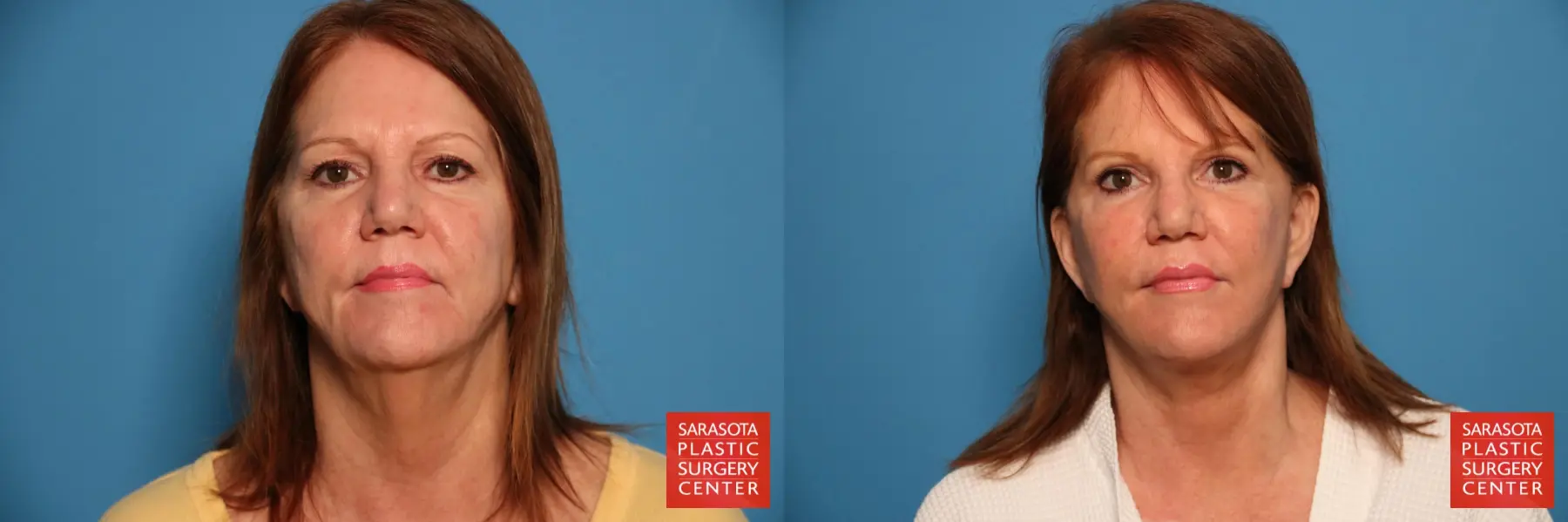 Facelift: Patient 14 - Before and After  