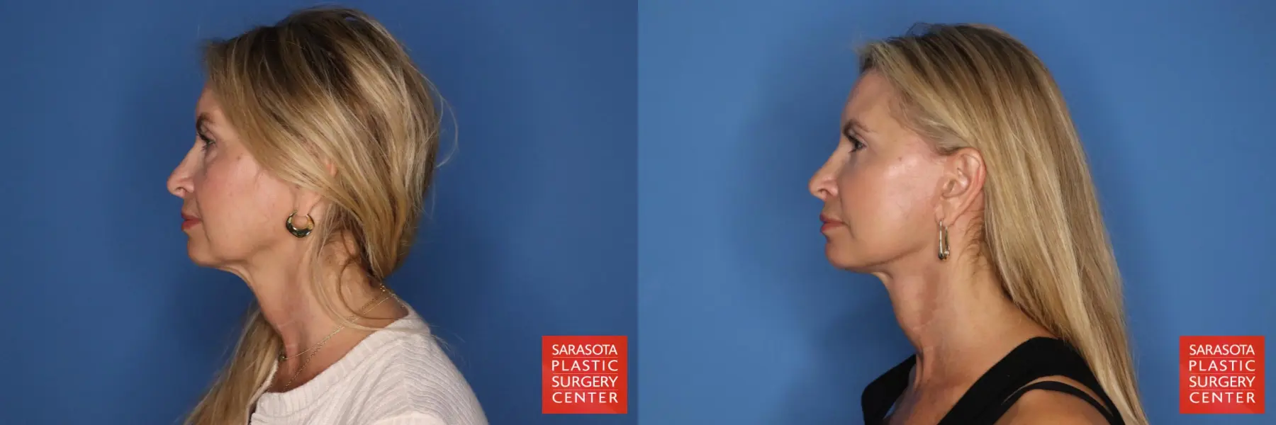 Facelift: Patient 89 - Before and After 5