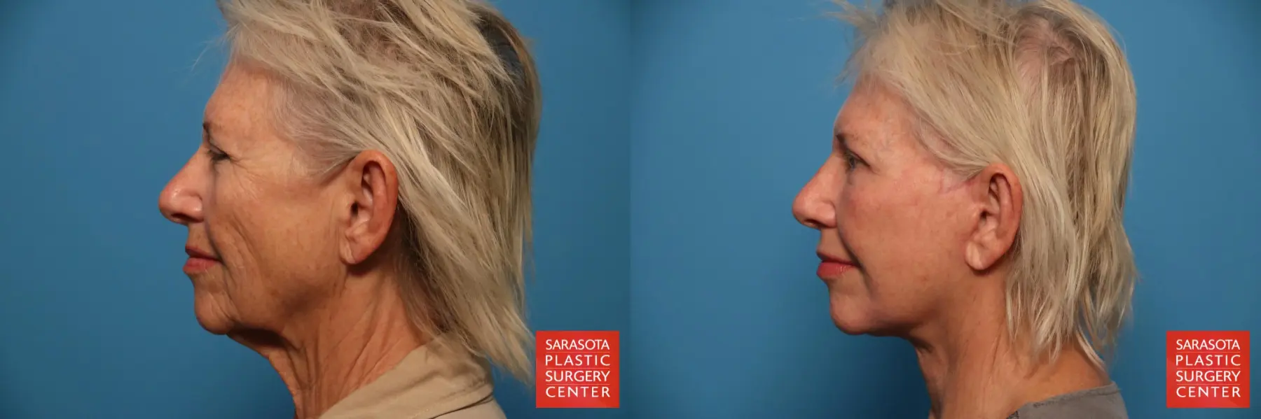 Facelift: Patient 42 - Before and After 5