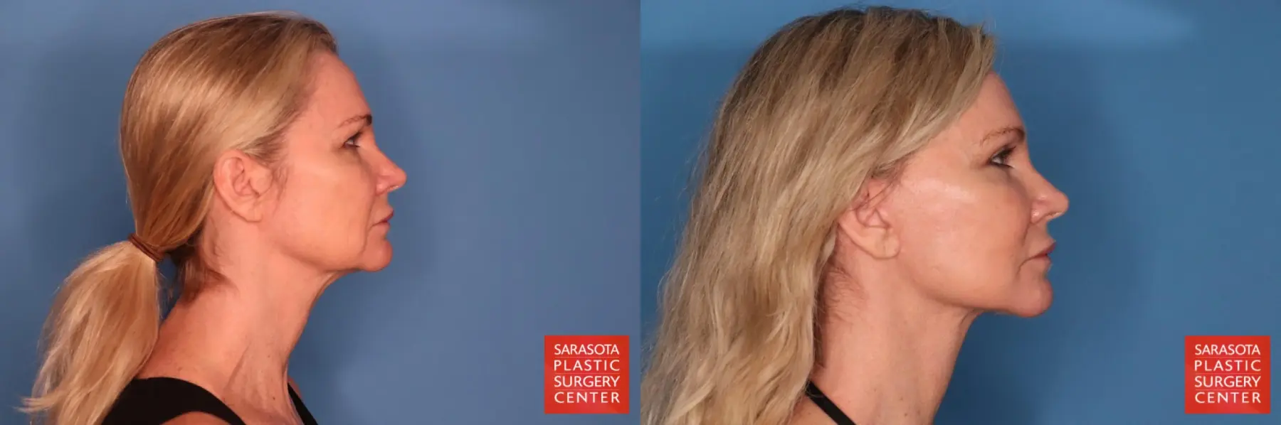 Facelift: Patient 108 - Before and After 5