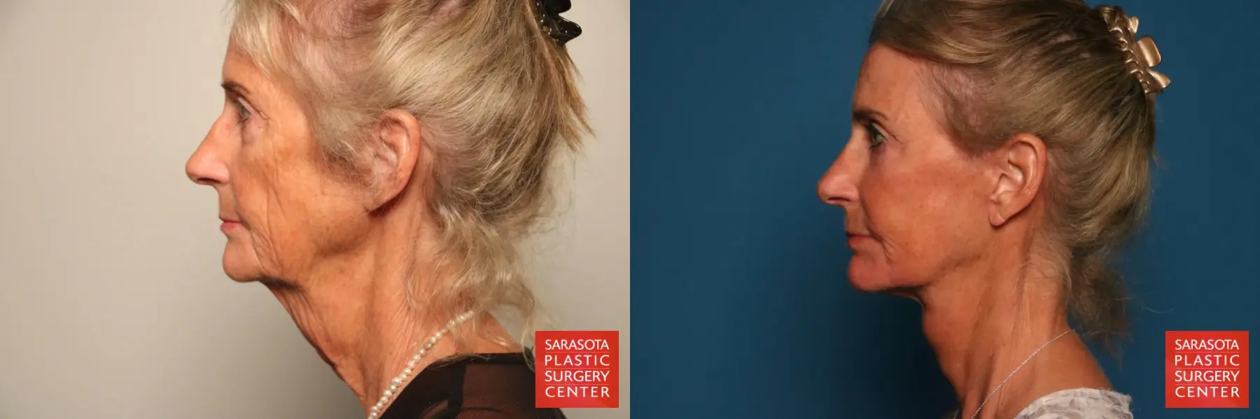 Facelift: Patient 18 - Before and After 3