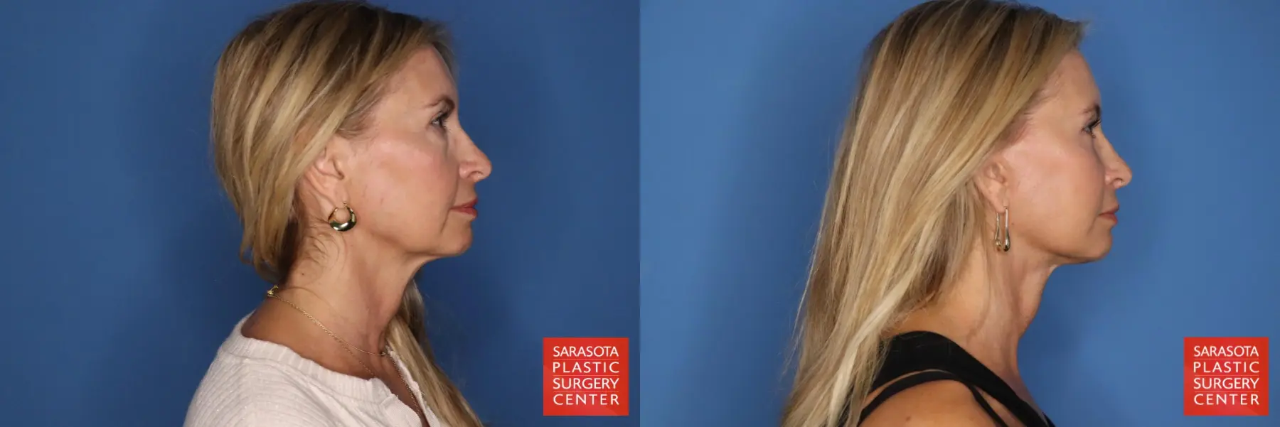 Facelift: Patient 89 - Before and After 3