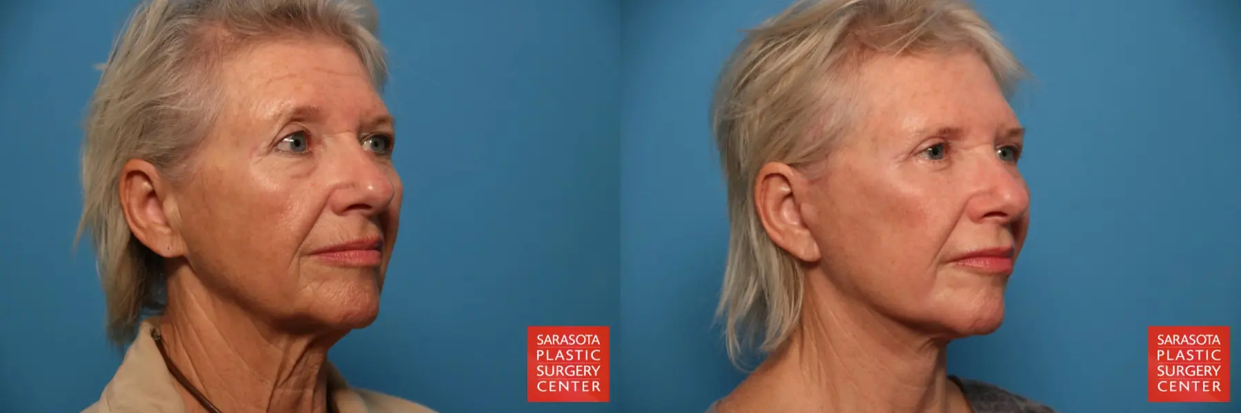 Facelift: Patient 42 - Before and After 2