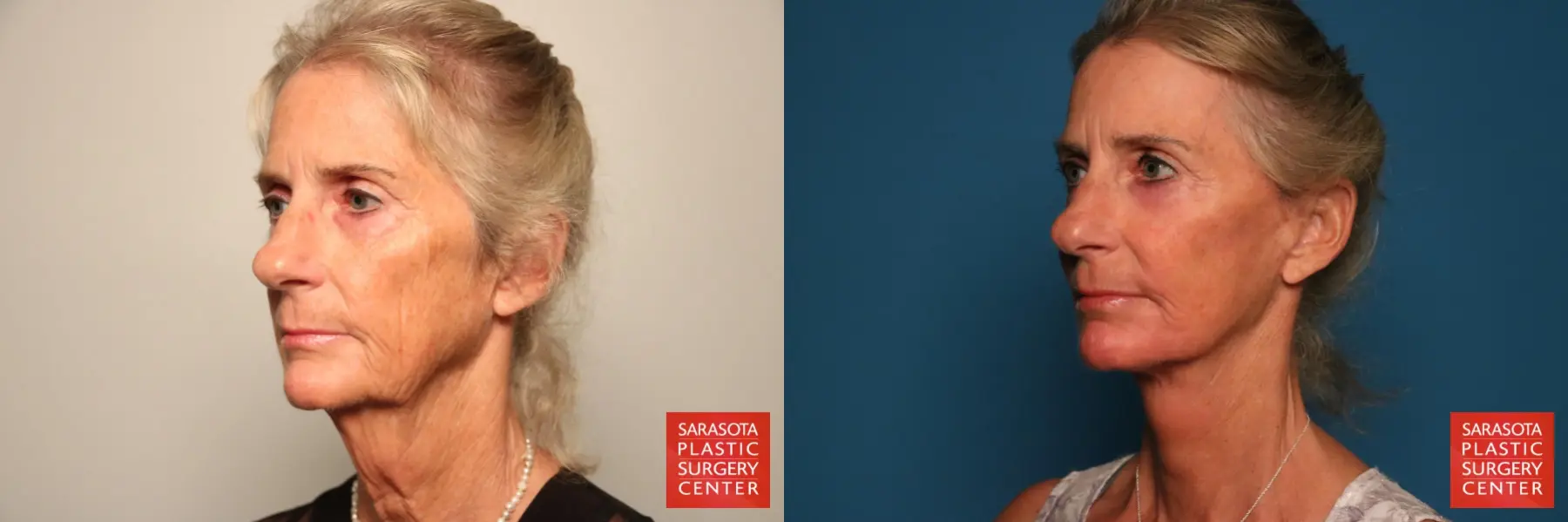 Facelift: Patient 18 - Before and After 2