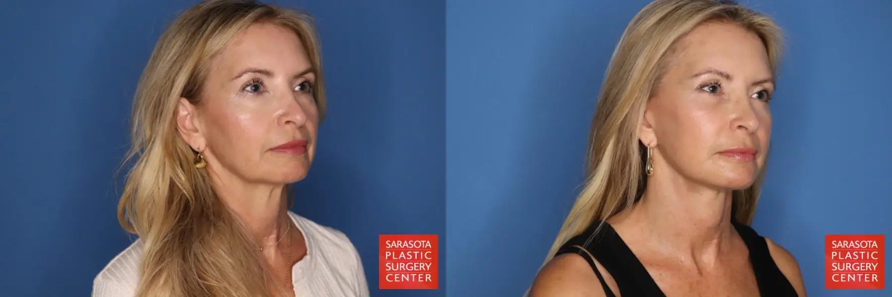 Facelift: Patient 89 - Before and After 2