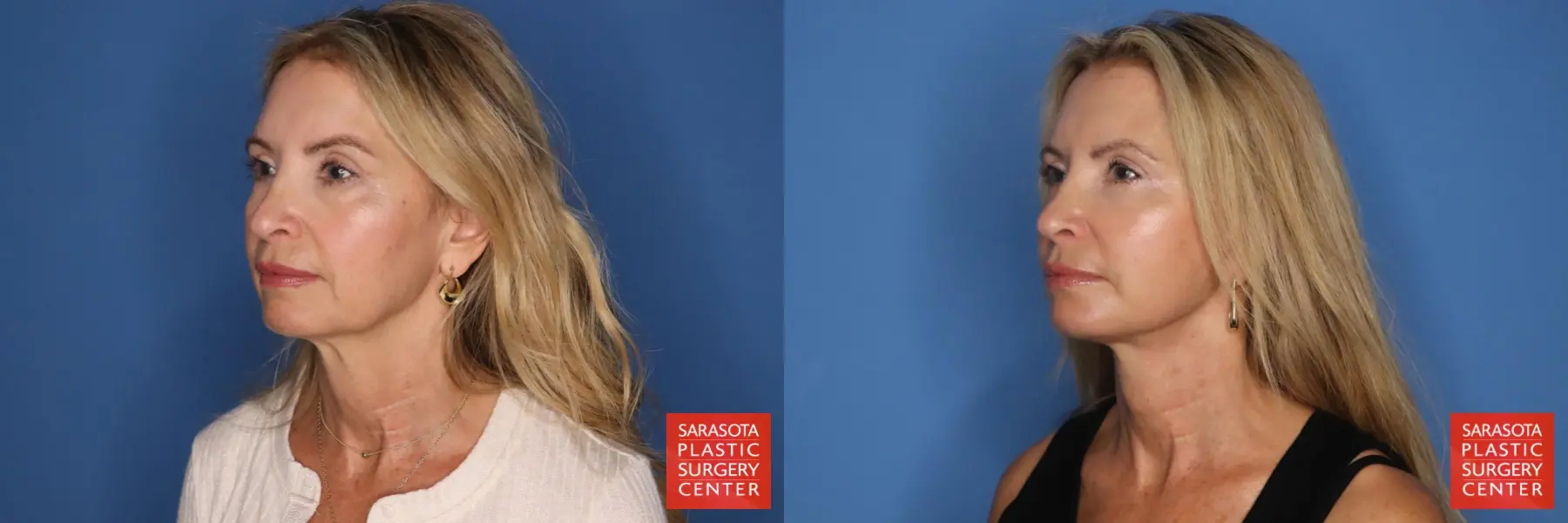 Facelift: Patient 89 - Before and After 4