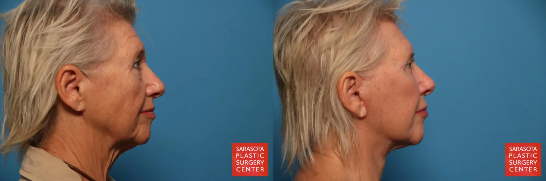 Facelift: Patient 42 - Before and After 3