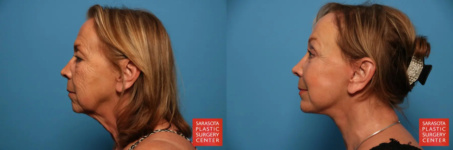 Facelift: Patient 33 - Before and After 3