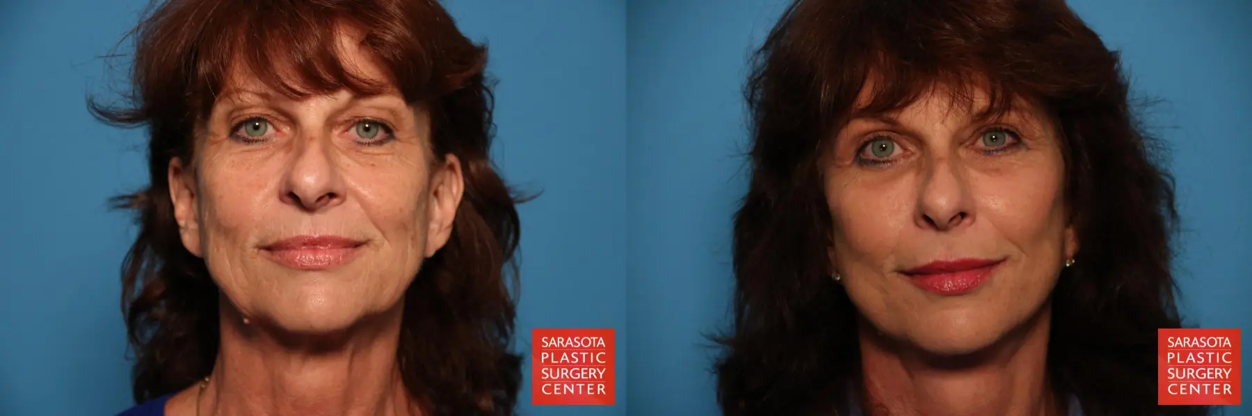 Facelift: Patient 4 - Before and After  