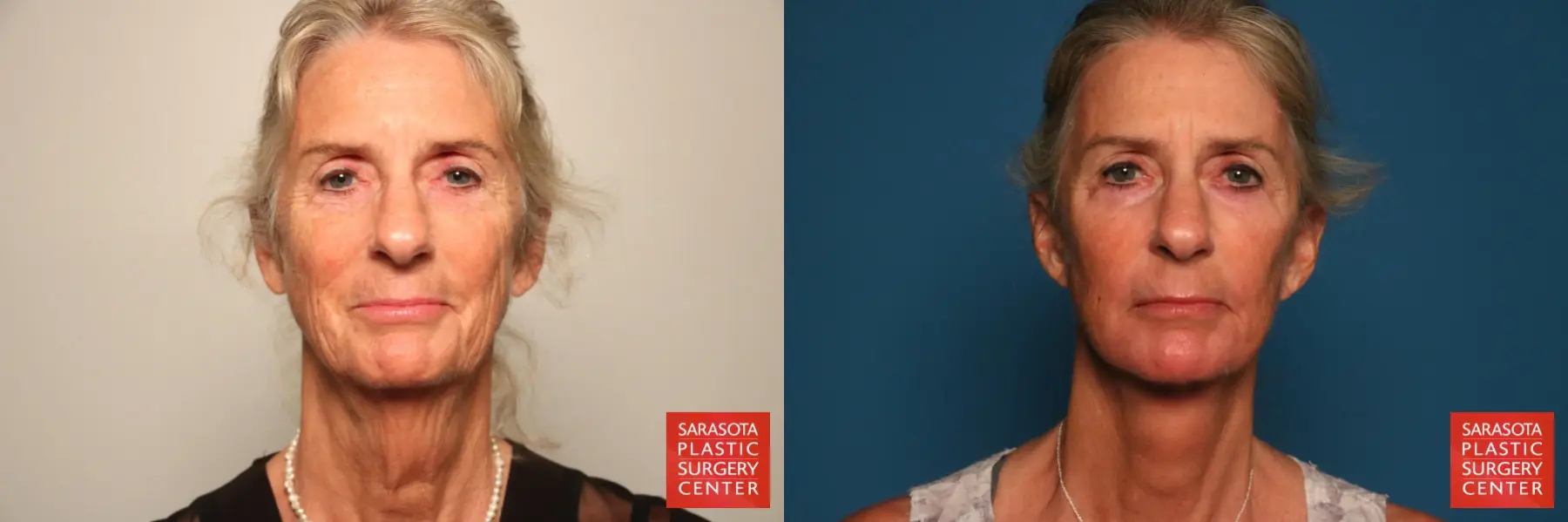 Facelift: Patient 18 - Before and After  
