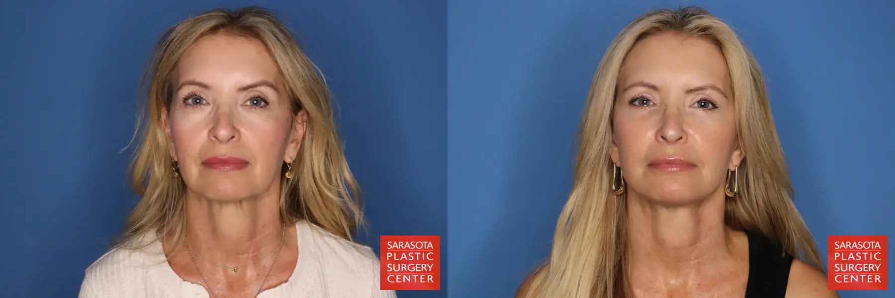 Facelift: Patient 89 - Before and After 1