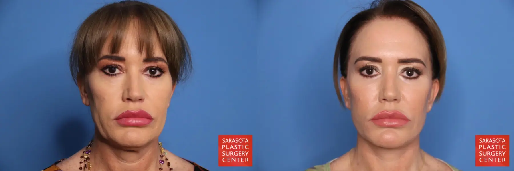 Facelift: Patient 54 - Before and After 1