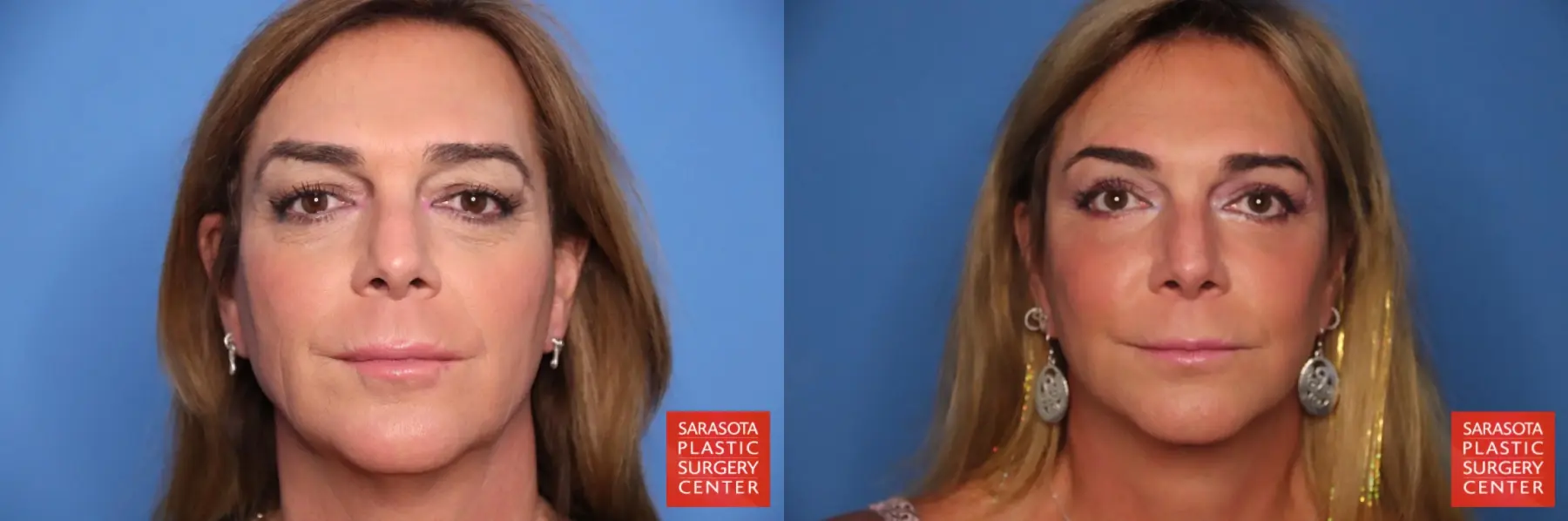 Facelift: Patient 79 - Before and After 1