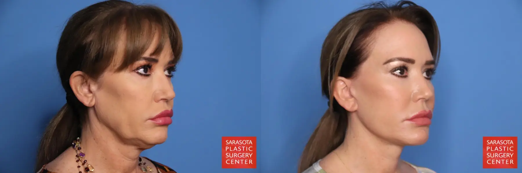Facelift: Patient 54 - Before and After 2
