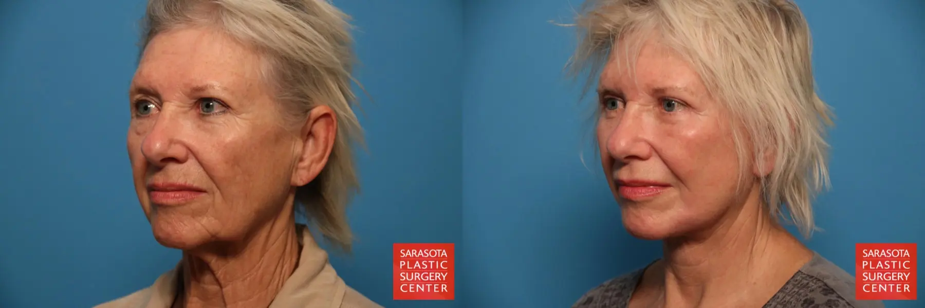 Facelift: Patient 42 - Before and After 4