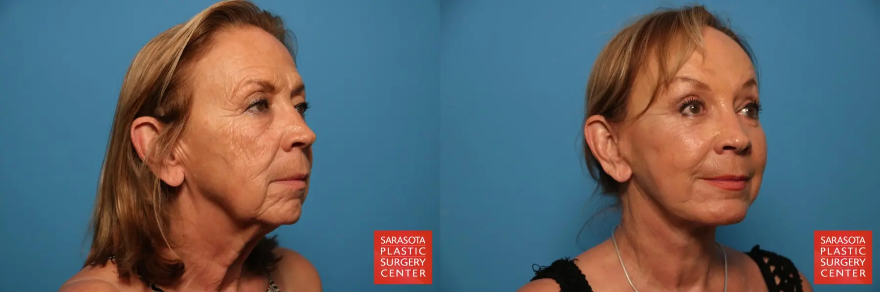 Facelift: Patient 33 - Before and After 4