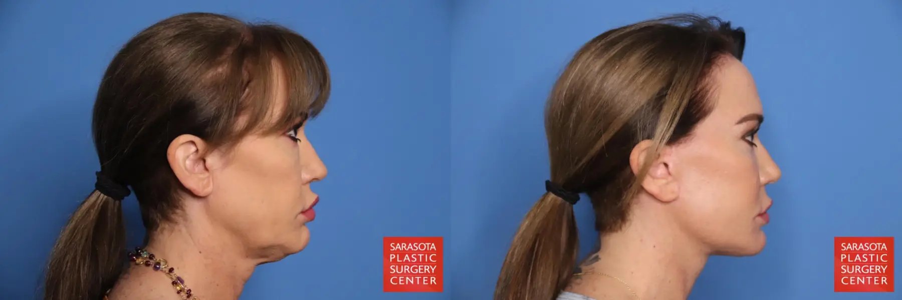 Facelift: Patient 54 - Before and After 3