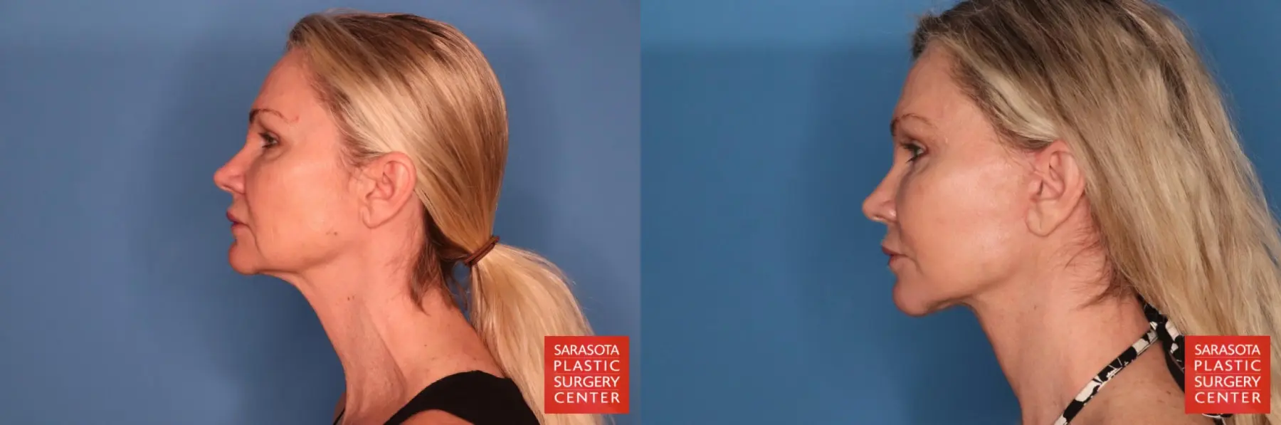 Facelift: Patient 108 - Before and After 3