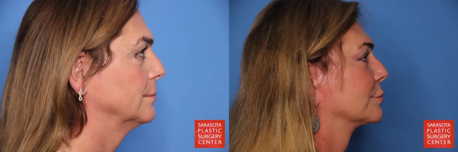 Facelift: Patient 79 - Before and After 5