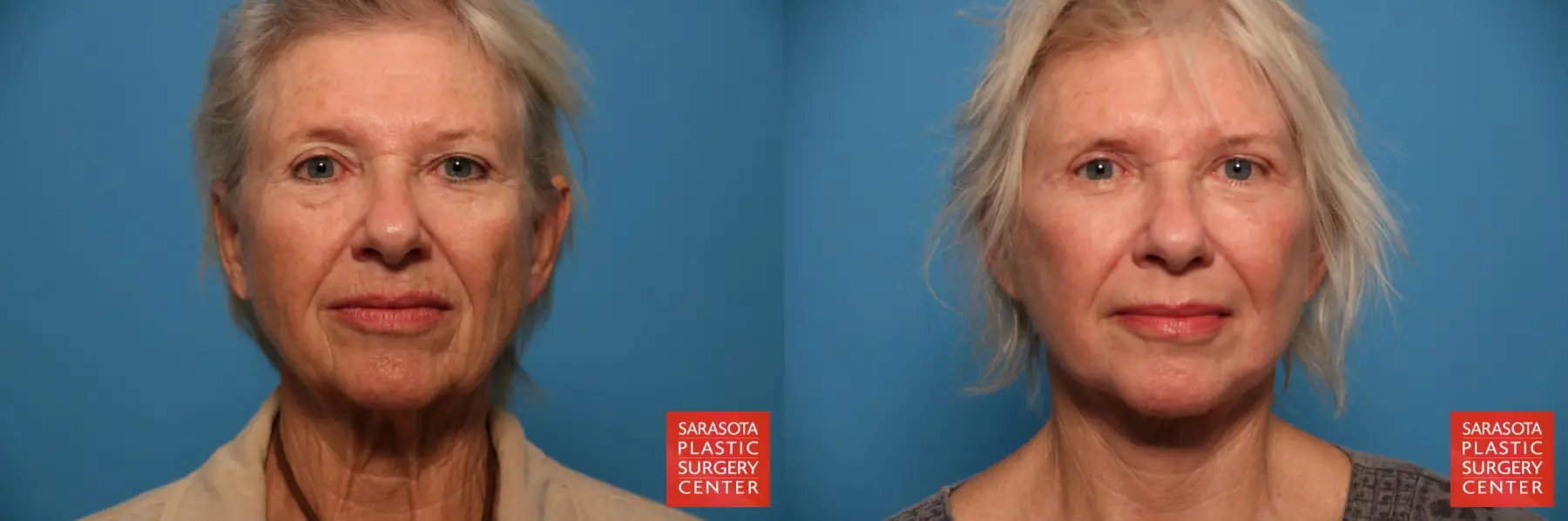 Facelift: Patient 42 - Before and After 1