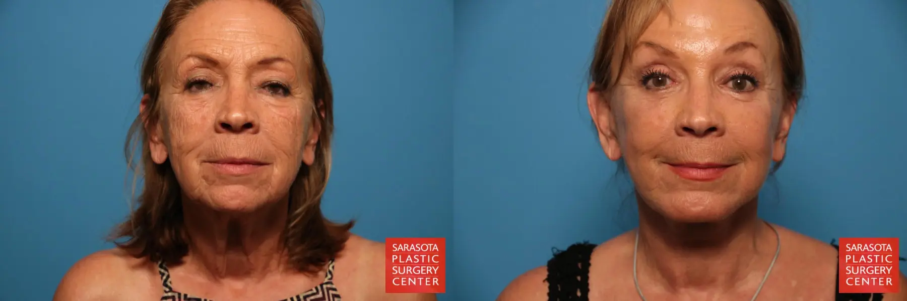 Facelift: Patient 33 - Before and After 1