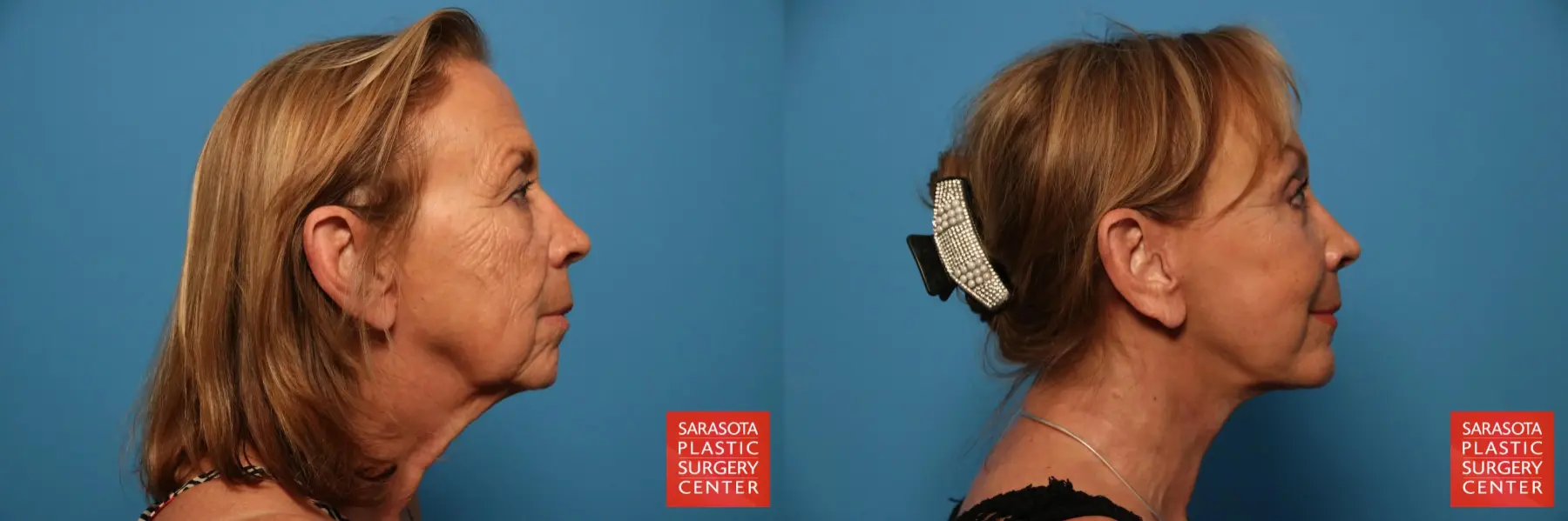 Facelift: Patient 33 - Before and After 5