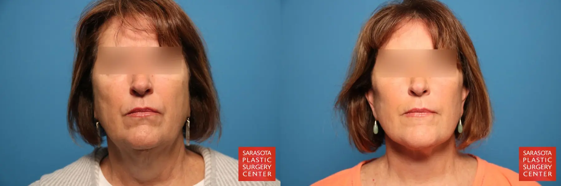 Facelift: Patient 15 - Before and After  