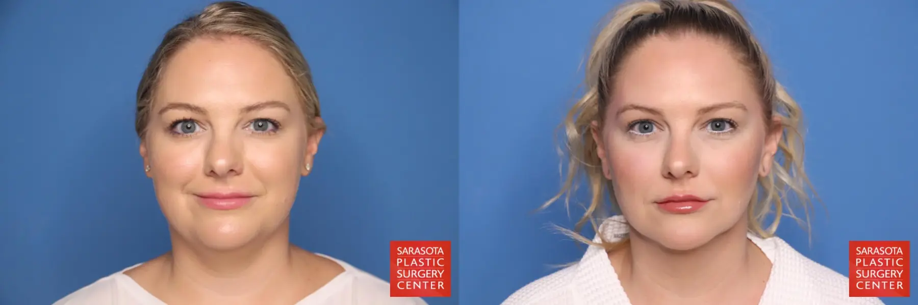 Facial Liposuction: Patient 8 - Before and After  