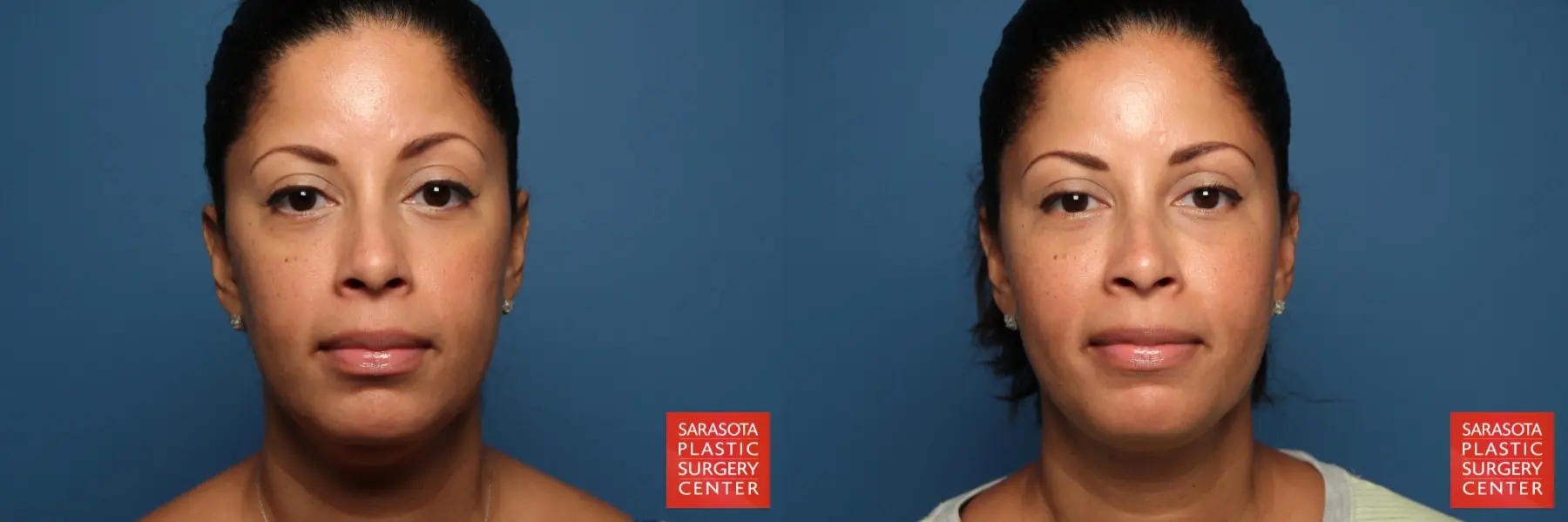 Facial Liposuction: Patient 3 - Before and After  