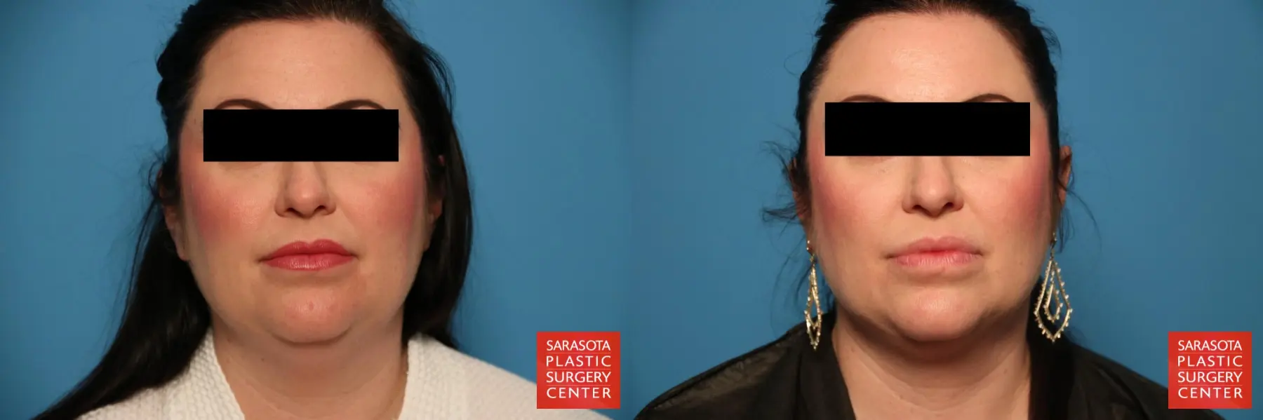 Facial Liposuction: Patient 1 - Before and After  