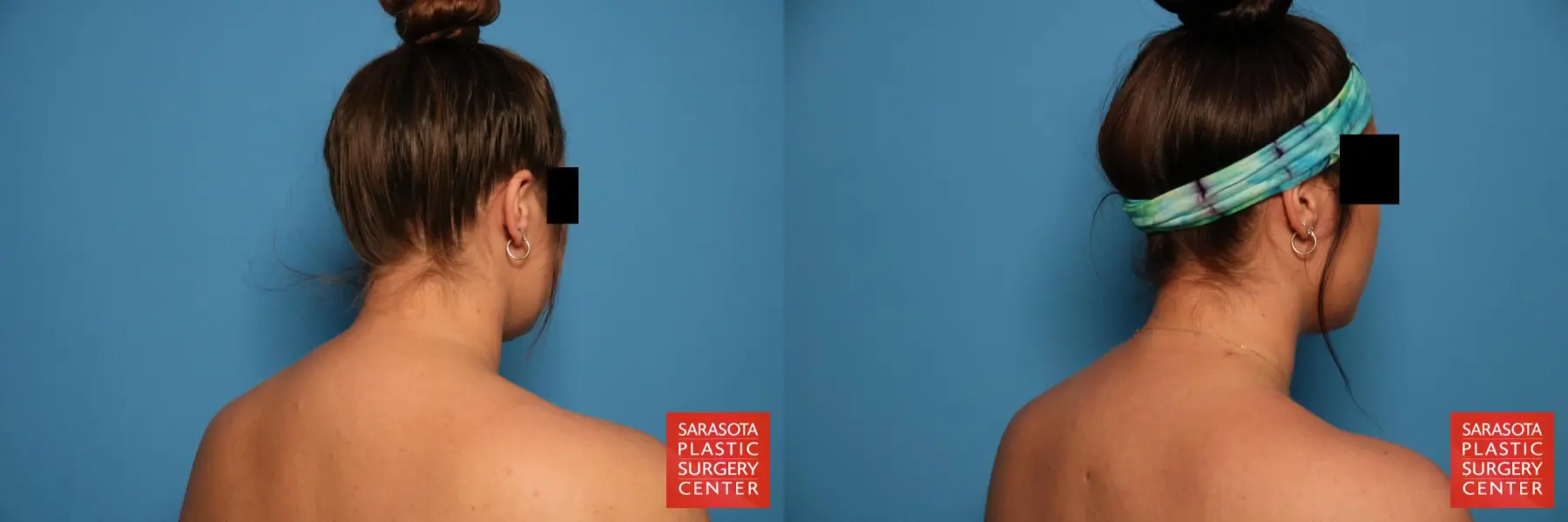 Facial Liposuction: Patient 5 - Before and After 5