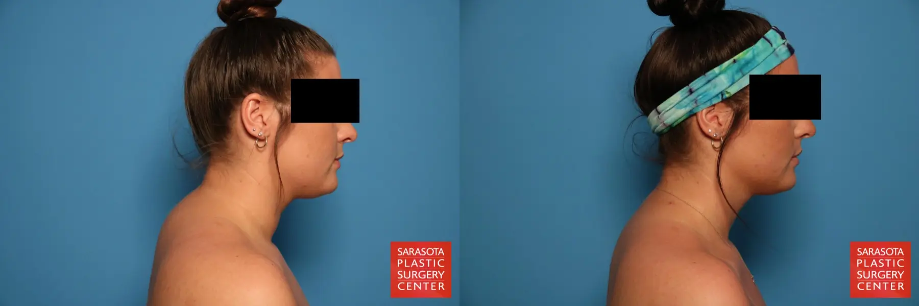 Facial Liposuction: Patient 5 - Before and After 4