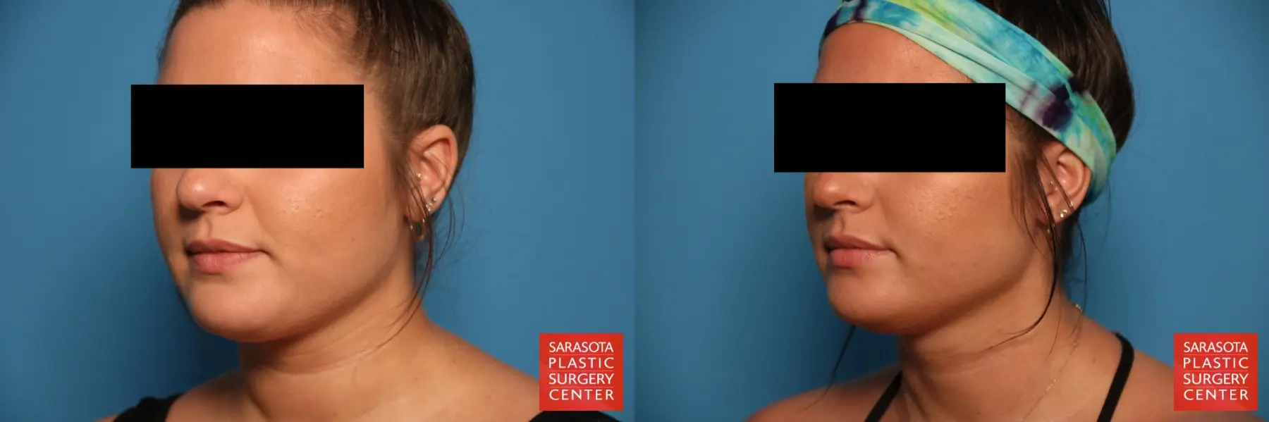Facial Liposuction: Patient 5 - Before and After 2