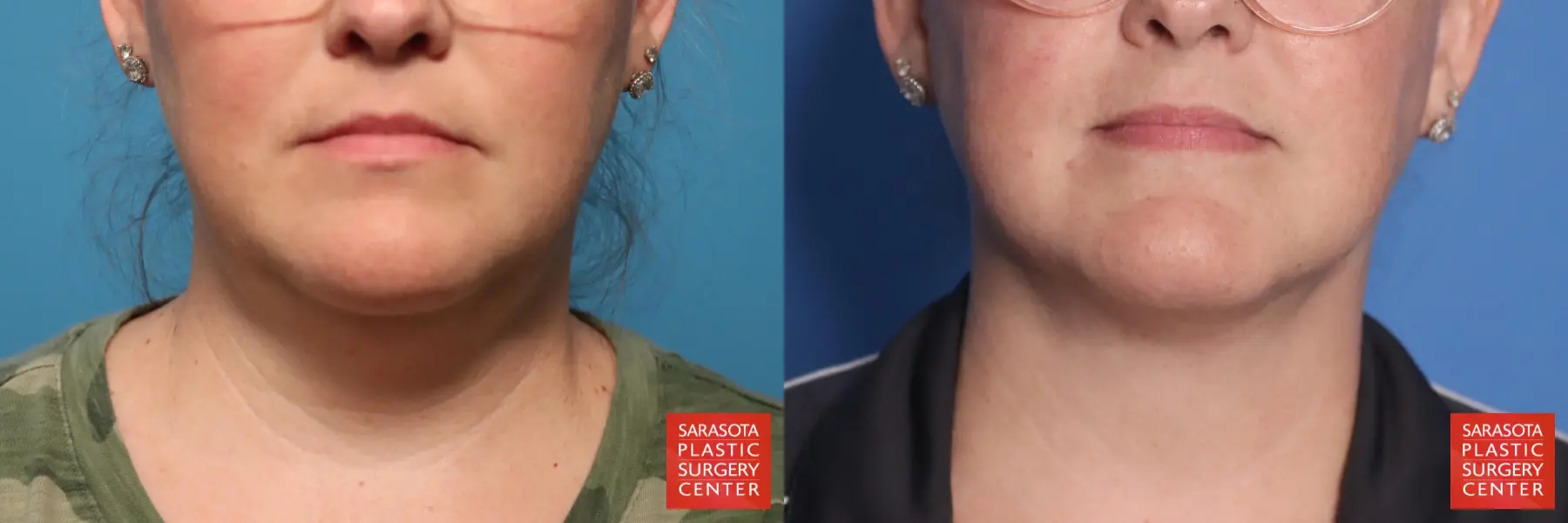 Facial Liposuction: Patient 7 - Before and After  