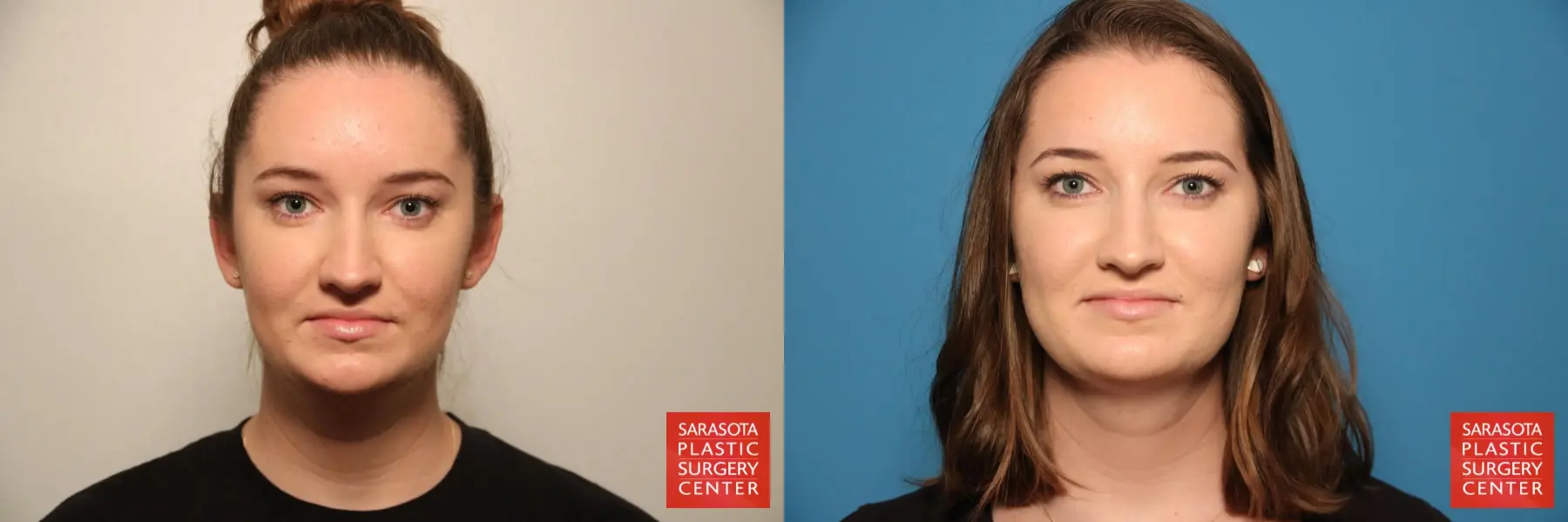 Facial Liposuction: Patient 4 - Before and After  