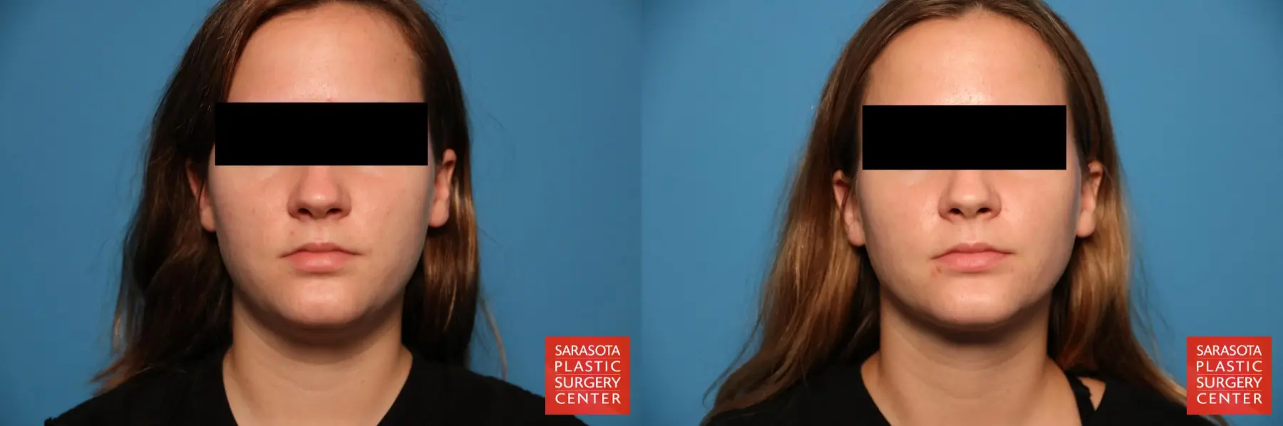 Facial Liposuction: Patient 6 - Before and After  