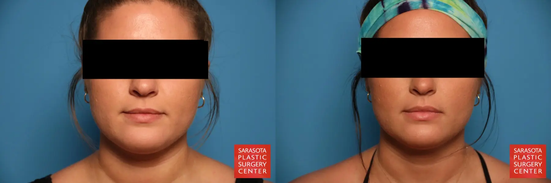 Facial Liposuction: Patient 5 - Before and After  