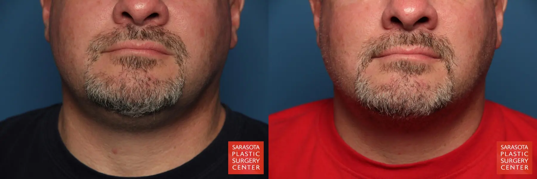 Facial Liposuction: Patient 2 - Before and After  